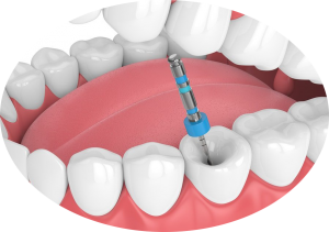 Algodones Dental Clinic root canal treatment